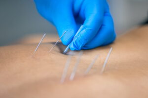 Close-up of dry needling therapy