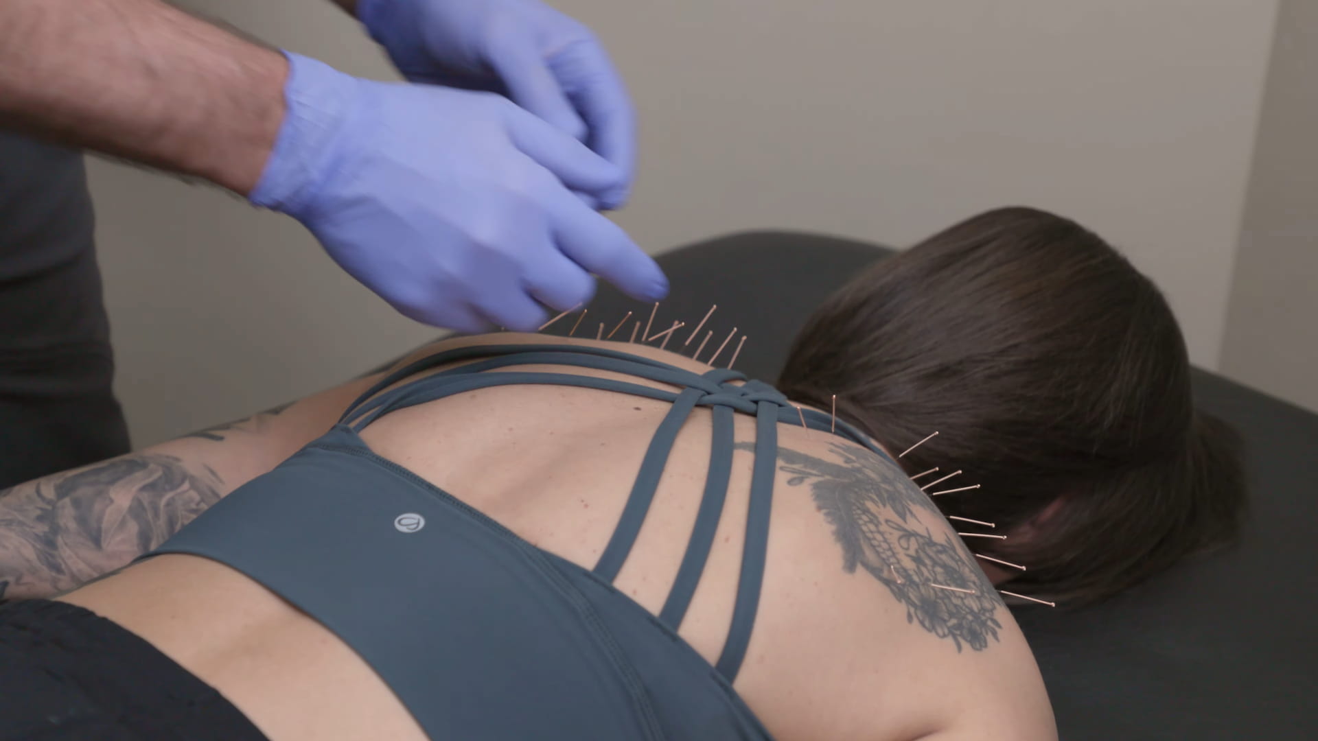 Upper back dry needling treatment